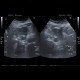 Carcionoid, pancreas, head of pancreas, calcification: US - Ultrasound